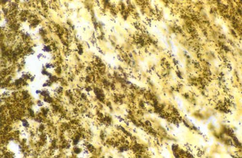 Warthin-Starry stain showing Bartonella henselae bacilli in cardiac valve tissue