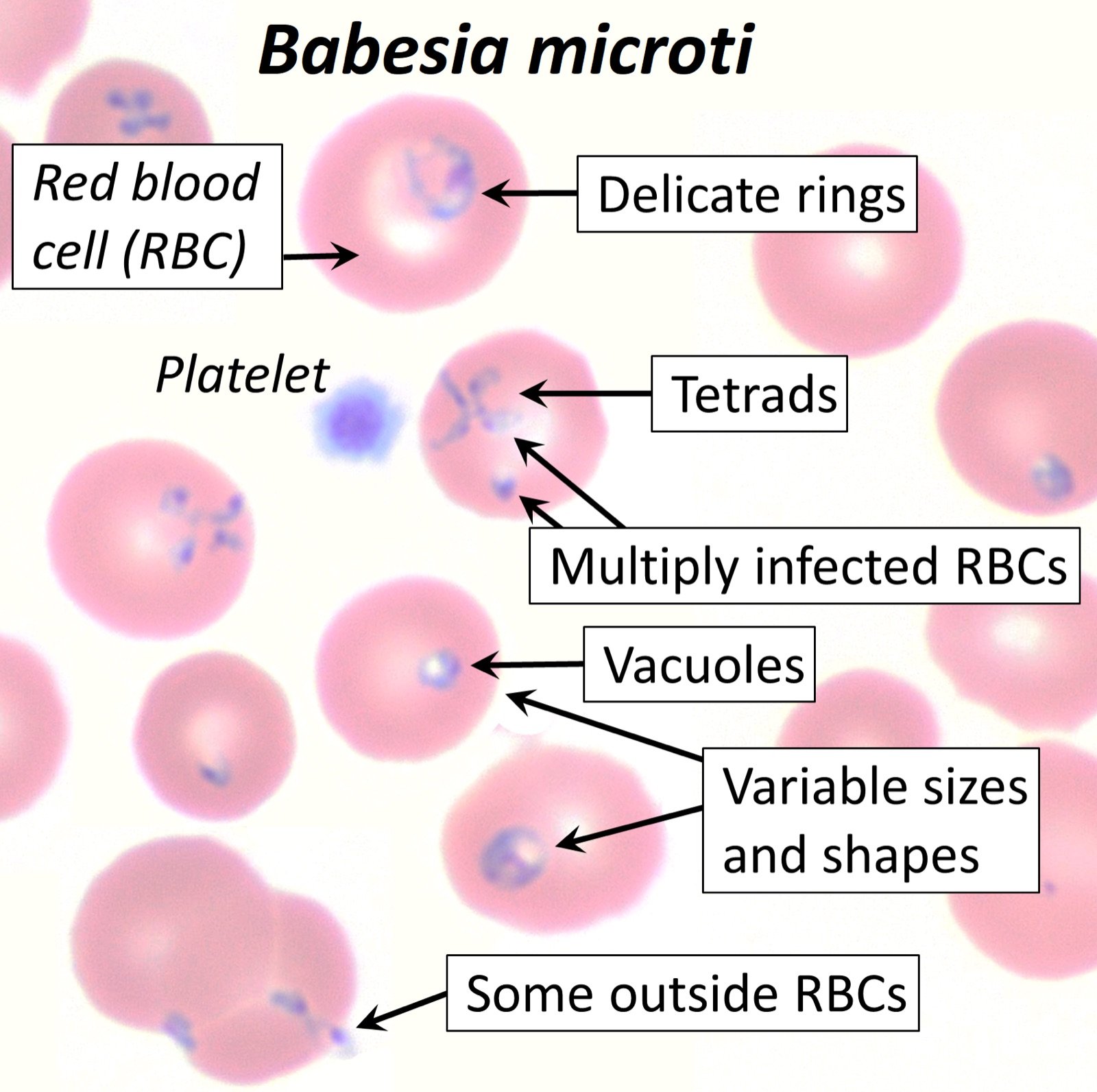 Babesia microti in red blood cells - annotated thin blood smear showing ring forms and tetrad